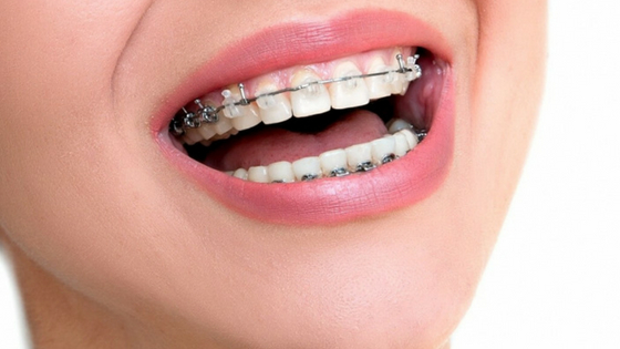 Braces muscat